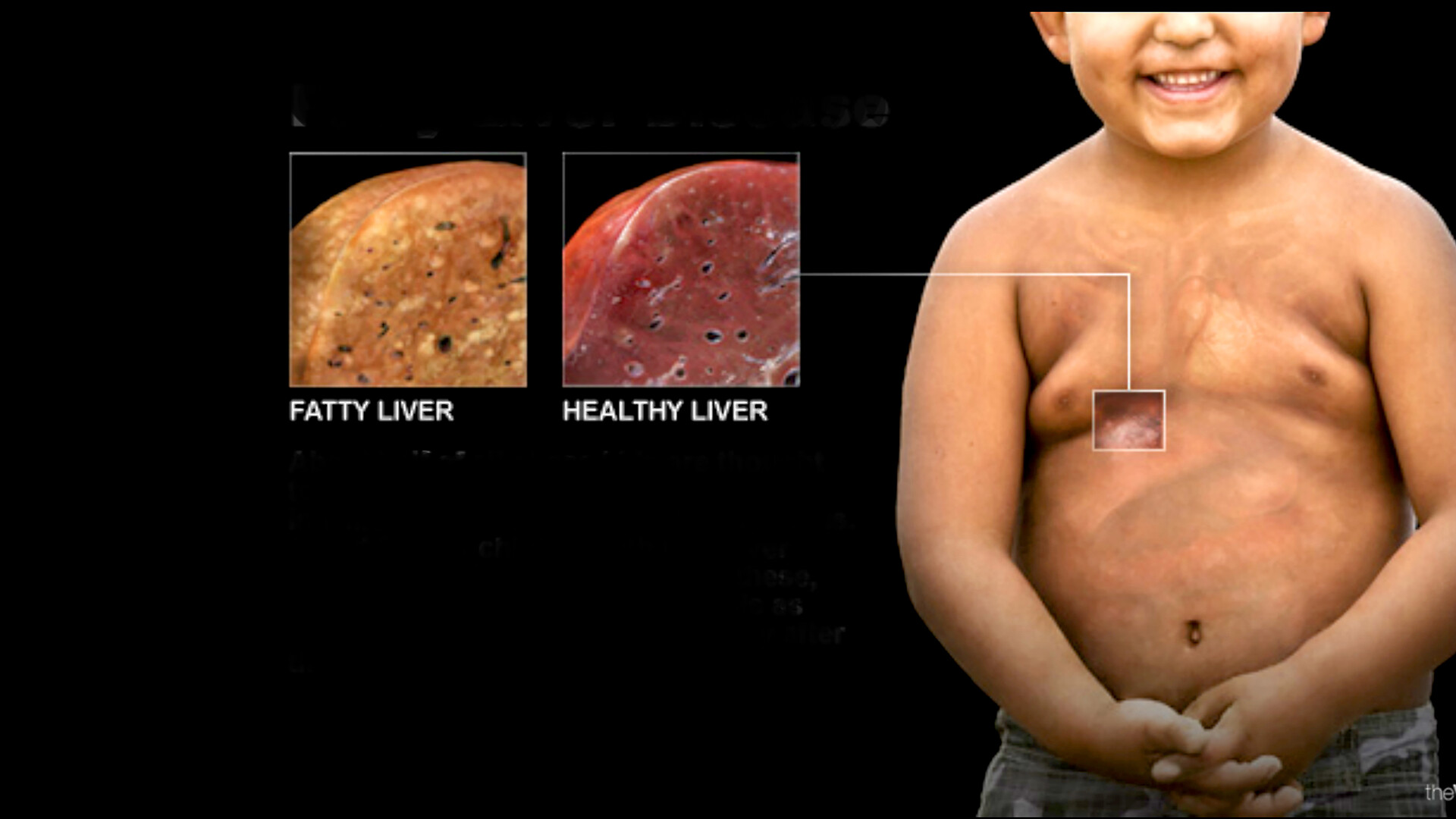 Growing concern over Fatty Liver Disease in India